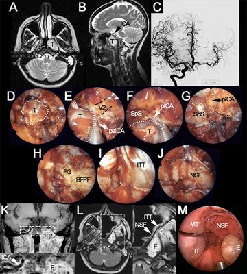 When Everything Revolves Around Internal Carotid Artery: Analysis of Different Management Strategies in Patients With Very Advanced Cancer Involving the Skull Base